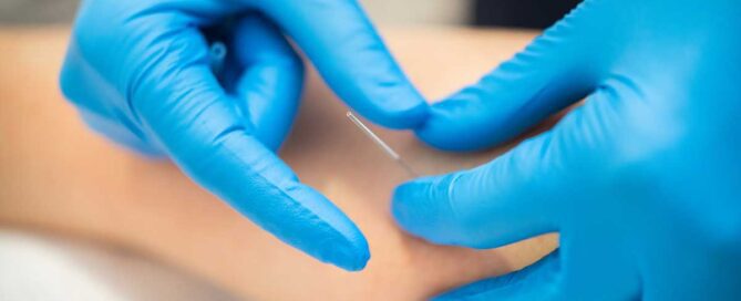 Dry Needling - Alton Physical Therapy